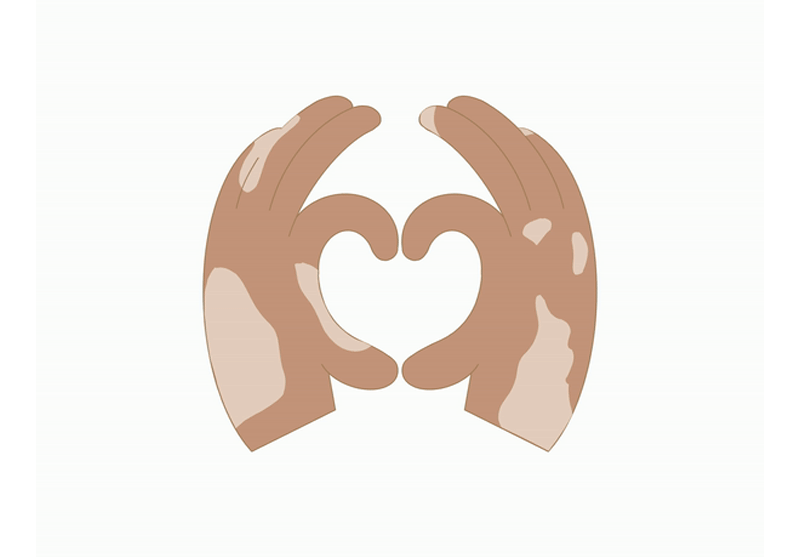 drcheena® Vitiligo Treatment Repigmentation Pack