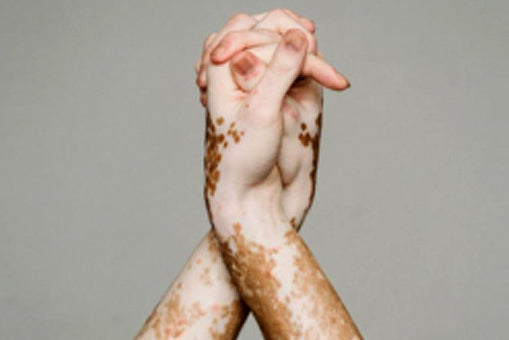 All You Need To Know About Vitiligo