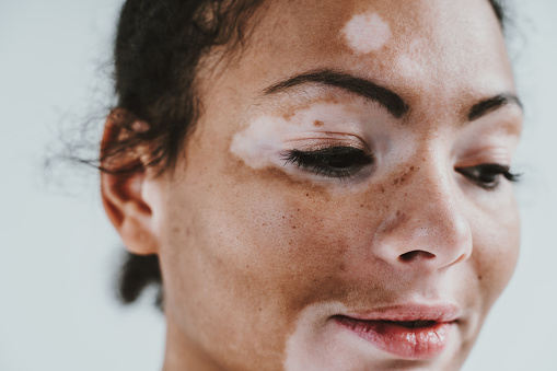 Vitiligo Treatment in India: A Comprehensive Guide