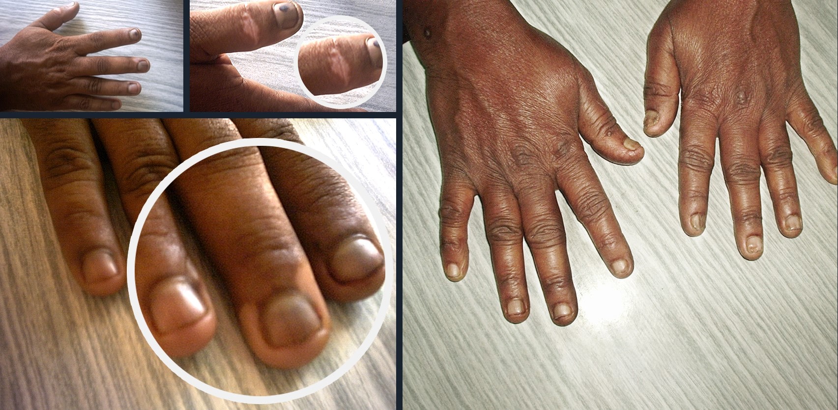 Patient suffering from Vitiligo treated by drcheena homeopathy achieved complete cure